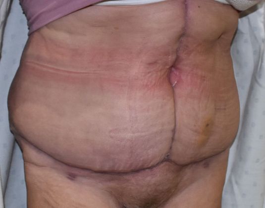 Massive Weight Loss : Case 77 - After