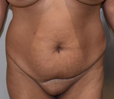 Tummy Tuck (Abdominoplasty): Case 259 - Before
