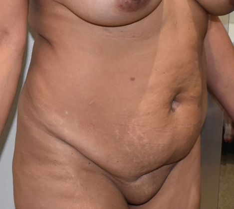 Tummy Tuck (Abdominoplasty): Case 259 - Before