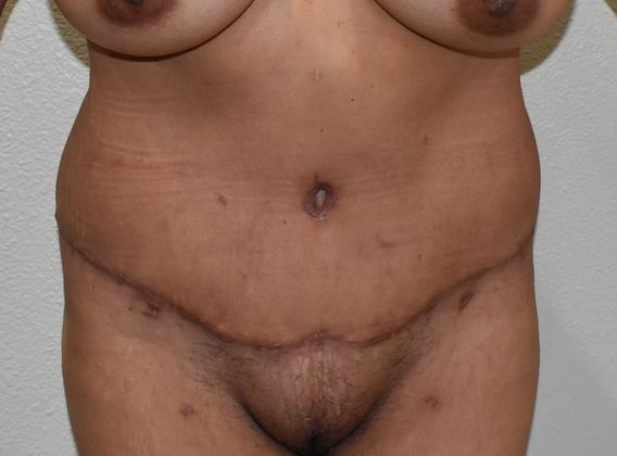 Tummy Tuck (Abdominoplasty): Case 259 - After