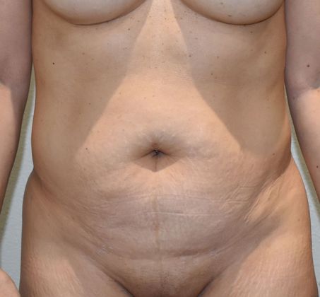 Tummy Tuck (Abdominoplasty): Case 260 - Before