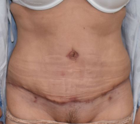 Tummy Tuck (Abdominoplasty): Case 261 - After