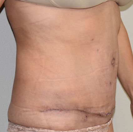 Tummy Tuck (Abdominoplasty): Case 261 - After