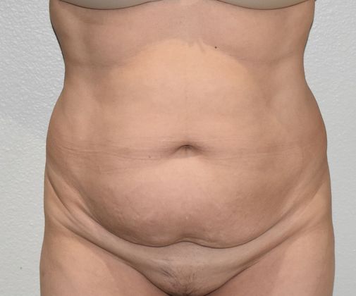 Tummy Tuck (Abdominoplasty): Case 261 - Before