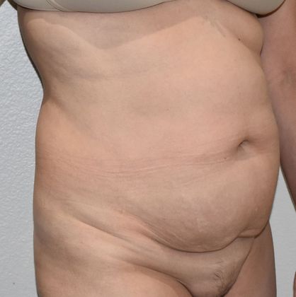 Tummy Tuck (Abdominoplasty): Case 261 - Before
