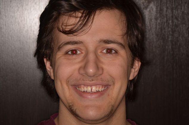 Dental Implants: Case 41 - After implant crown placement