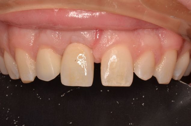 Dental Implants: Case 41 - After implant crown.  Patient wanted to keep Diastema