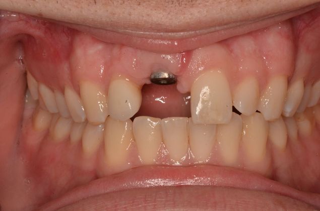 Dental Implants: Case 41 - After implant placement
