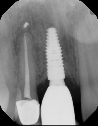 Dental Implants: Case 41 - Radiograph of implant crown