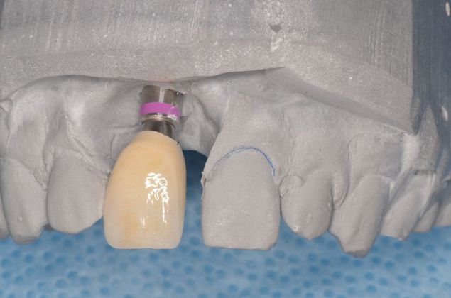 Dental Implants: Case 41 - Implant crown on the lab model