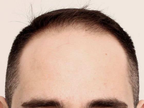 Male Before And After Hair Transplant Photos Frontal FUE (3) - Before
