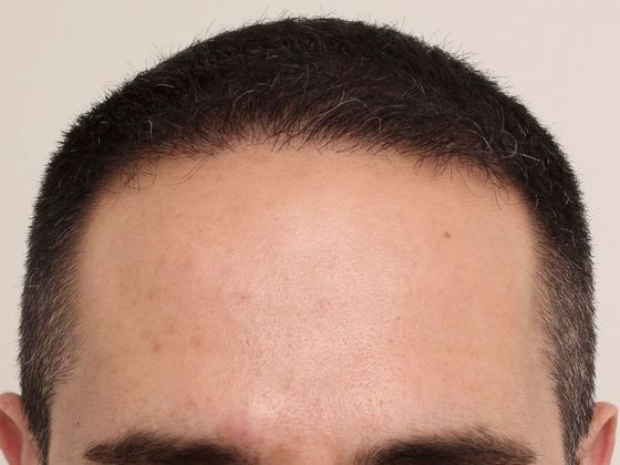 Male Before And After Hair Transplant Photos Frontal FUE (3) - After