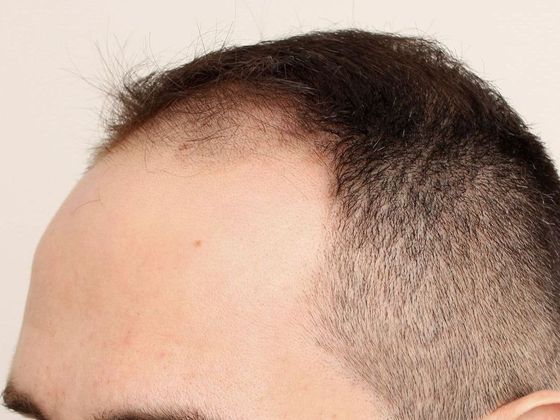 Hair Transplant - Male: Frontal FUE - Case 26 - Before FUE hair transplant