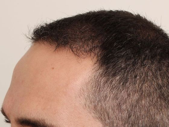 Hair Transplant - Male: Frontal FUE - Case 26 - After FUE hair transplant