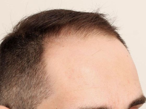 Hair Transplant - Male: Frontal FUE - Case 26 - Before FUE hair transplant