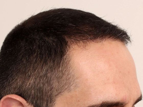 Hair Transplant - Male: Frontal FUE - Case 26 - After FUE hair transplant