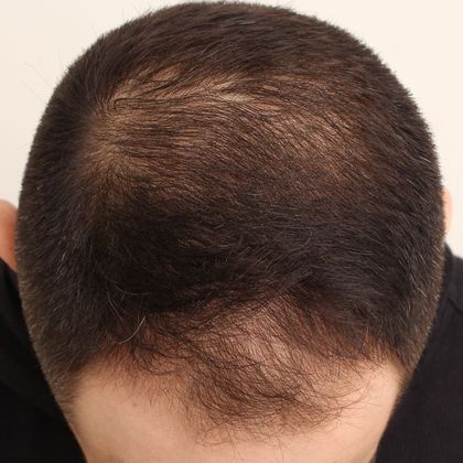 Hair Transplant - Male: Frontal FUE - Case 26 - Before FUE hair transplant