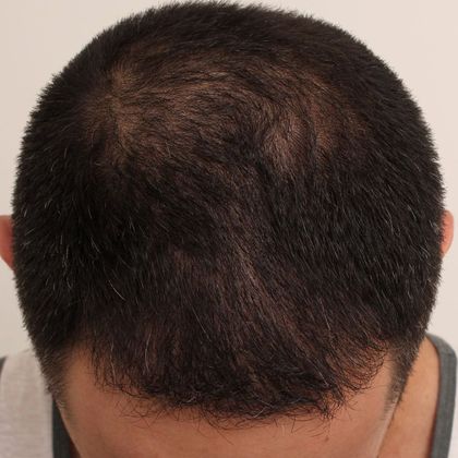 Hair Transplant - Male: Frontal FUE - Case 26 - After FUE hair transplant