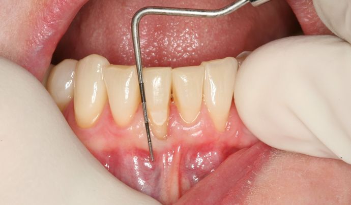 Laser Dentistry & Gum Recontouring Case