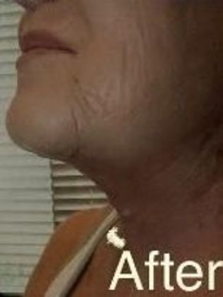 Chin Augmentation Case 1 - After