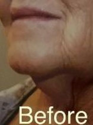 Neck Lift Case 1 - Before