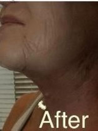 Neck Lift Case 1 - After