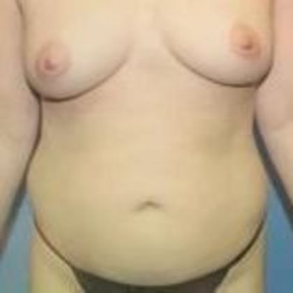 Mommy Makeover Case 2 - Before