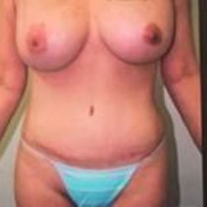 Mommy Makeover Case 2 - After