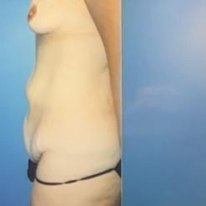 Mommy Makeover Case 3 - Before