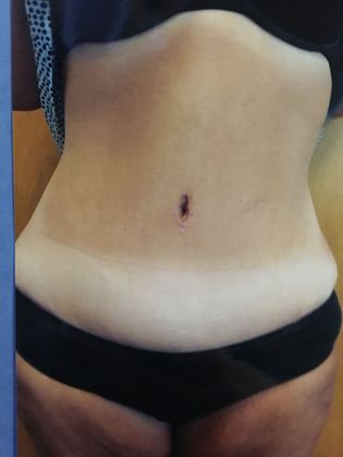 Abdominoplasty Case 2 - After