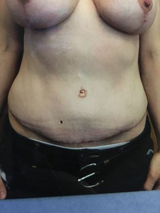 Abdominoplasty Case 2 - Before