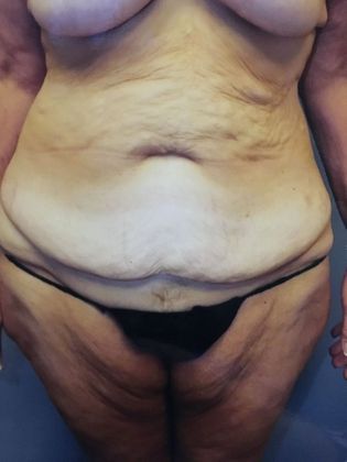 Tummy Tuck Case 6 - Before