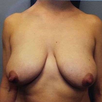 Breast Augmentation Case 7 - Before