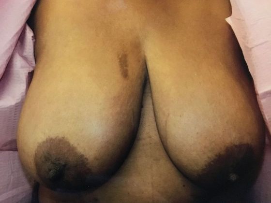 Breast Augmentation Case 9 - Before