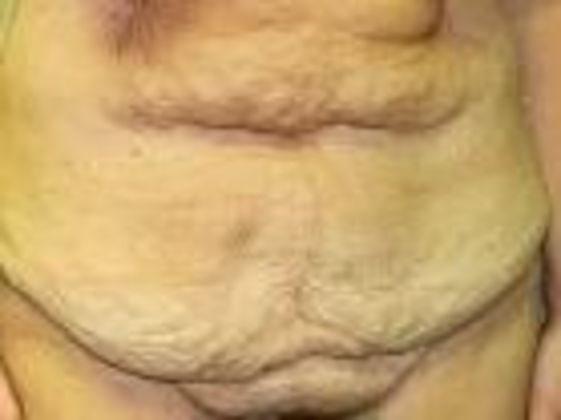 Abdominoplasty Case 3 - Before