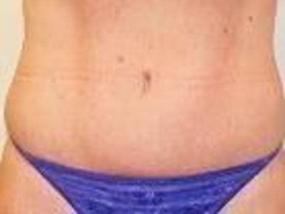 Abdominoplasty Case 3 - After