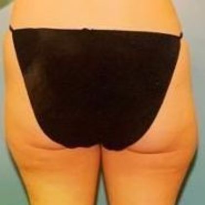 Body Contouring: Case 1 - Before