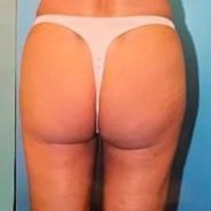 Body Contouring: Case 1 - After