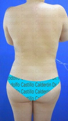 Liposuction: Lipoescultura con lipotransferencia/ liposculpture with Brazilian Butt - Before