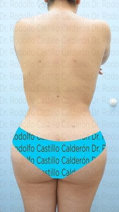 Liposuction: Lipoescultura con lipotransferencia/ liposculpture with Brazilian Butt - After