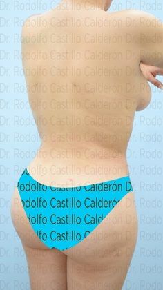 Liposuction: Lipoescultura con lipotransferencia/ liposculpture with Brazilian Butt - After