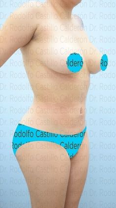 Liposuction: Lipoescultura con lipotransferencia/ liposculpture with Brazilian Butt - After
