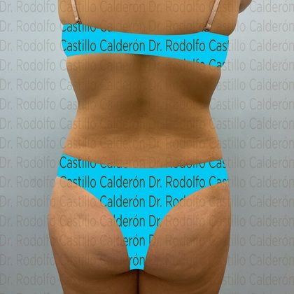Liposuction: Patient with no pregnancies who wants to improve her body shape - Before