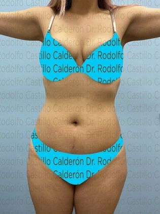 Liposuction: Patient with no pregnancies who wants to improve her body shape - Before