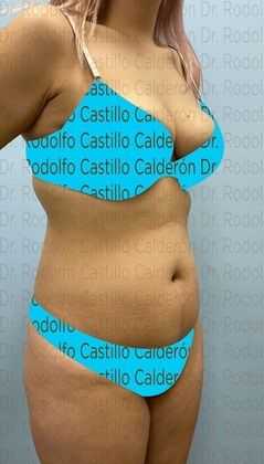 Liposuction Patient with no pregnancies who wants to improve her body shape - Before