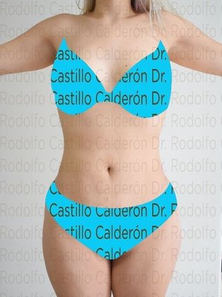 Liposuction: Patient with no pregnancies who wants to improve her body shape - After