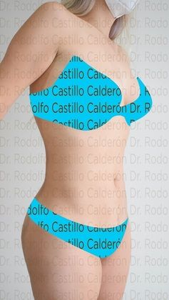 Liposuction Patient with no pregnancies who wants to improve her body shape - After