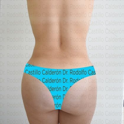 Liposuction: Patient with no pregnancies who wants to improve her body shape - After