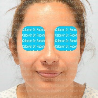 Rhinoplasty: Secondary Rhinoplasty - Case1 - Before