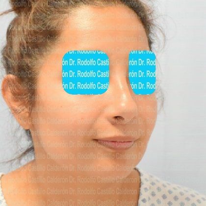 Rhinoplasty: Secondary Rhinoplasty - Case1 - Before